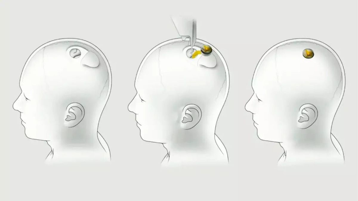 Elsőként ültetett chipet élő emberi agyba Elon Musk cége